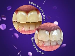At-Home Teeth Whitening "Pre-Filled Trays" By Burst