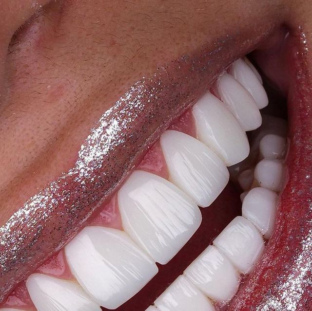 Porcelain Veneers