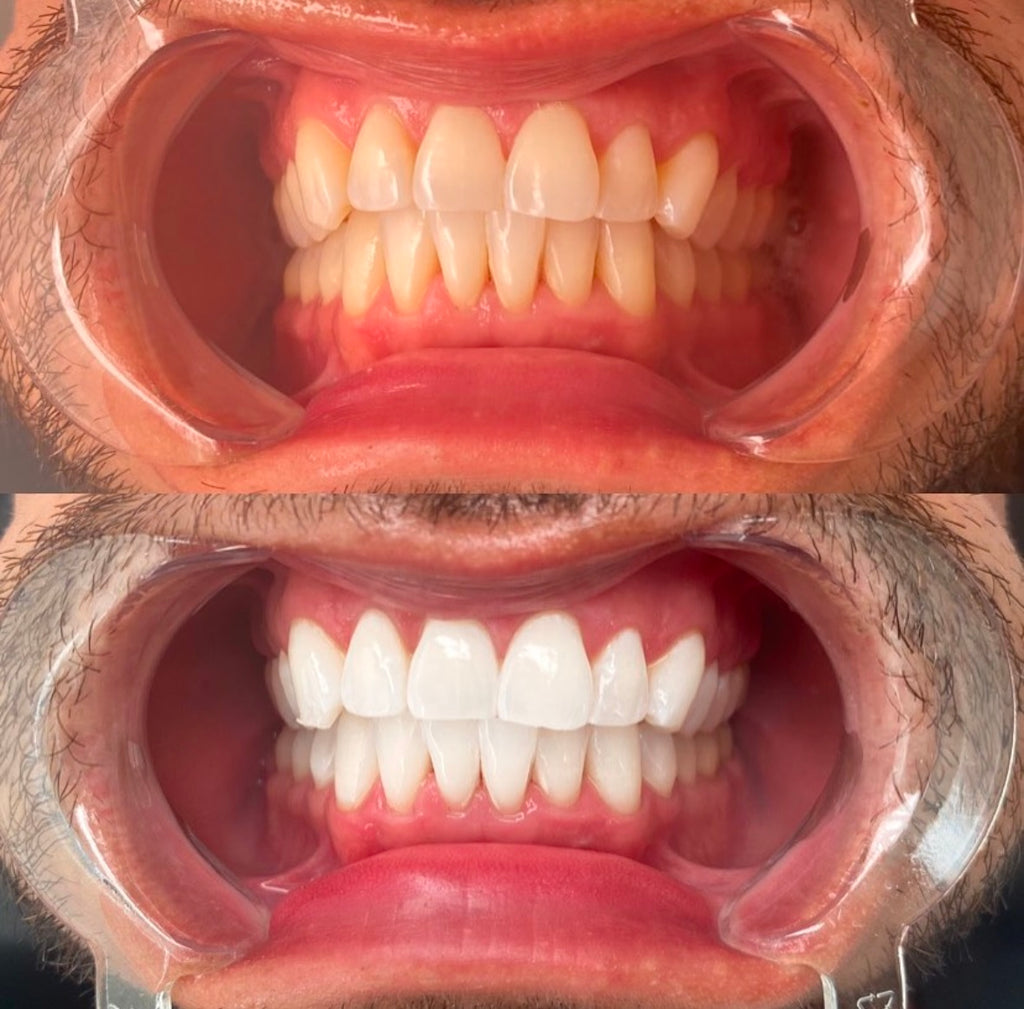1 Hour Teeth Whitening