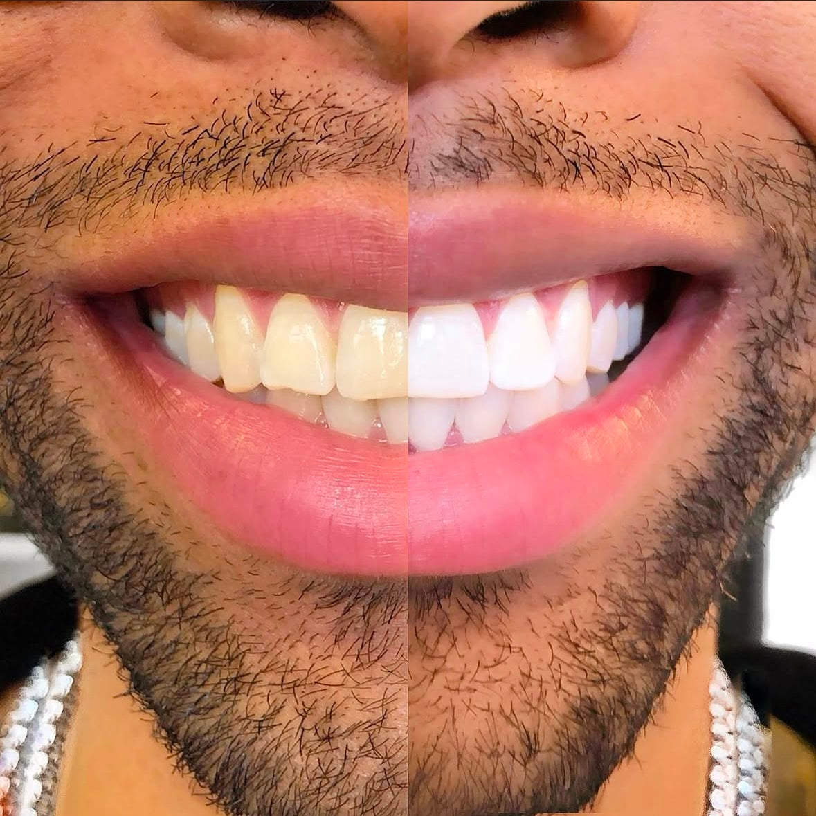 1 Hour Teeth Whitening Session