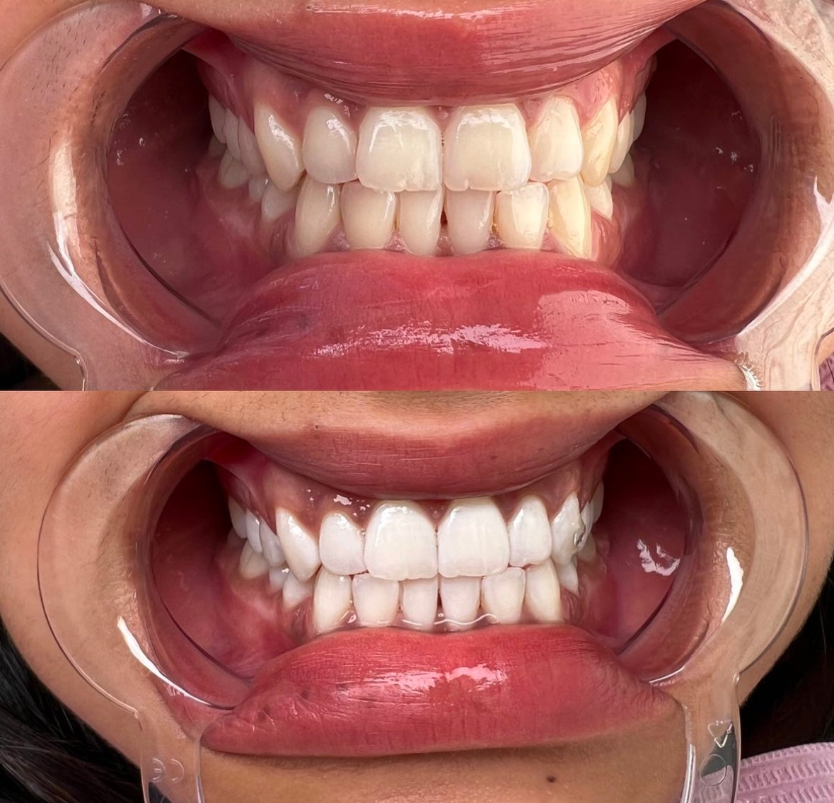 1 Hour Teeth Whitening