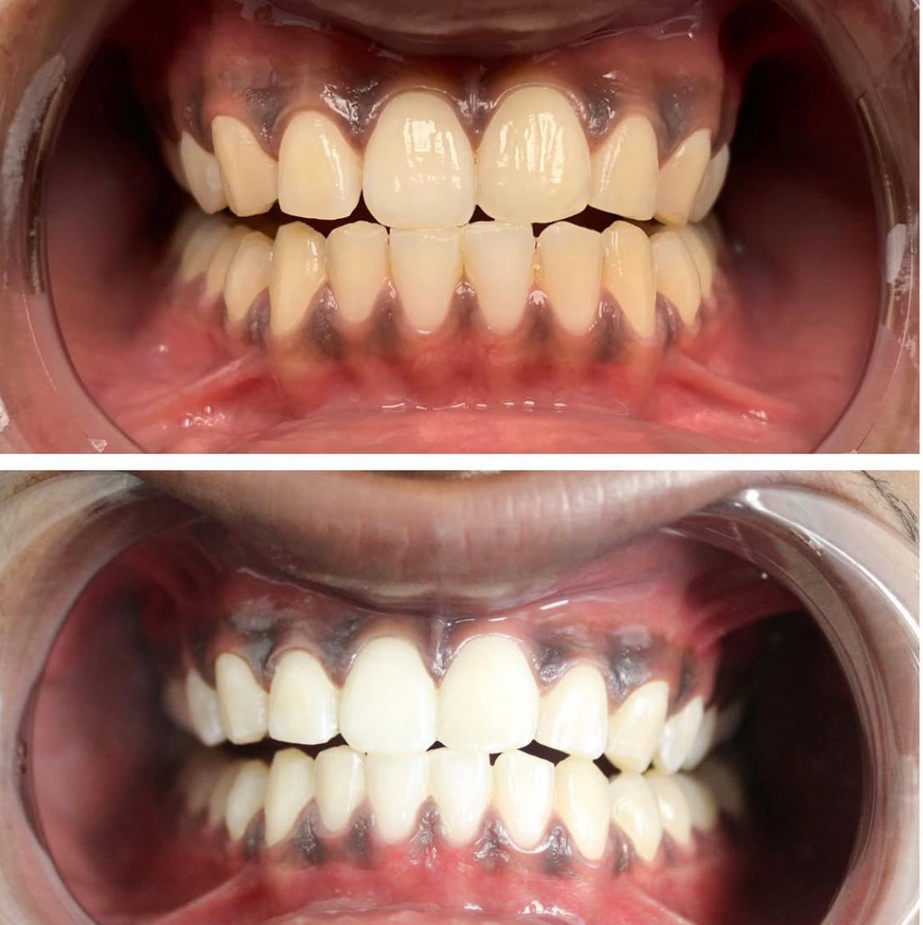 1 Hour Teeth Whitening