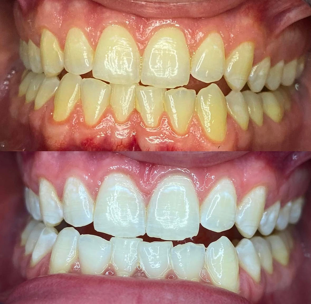 1 Hour Teeth Whitening