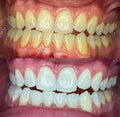 1 Hour Teeth Whitening
