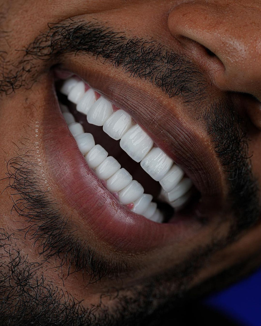 Porcelain Veneers