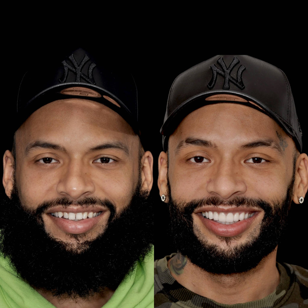 Porcelain Veneers