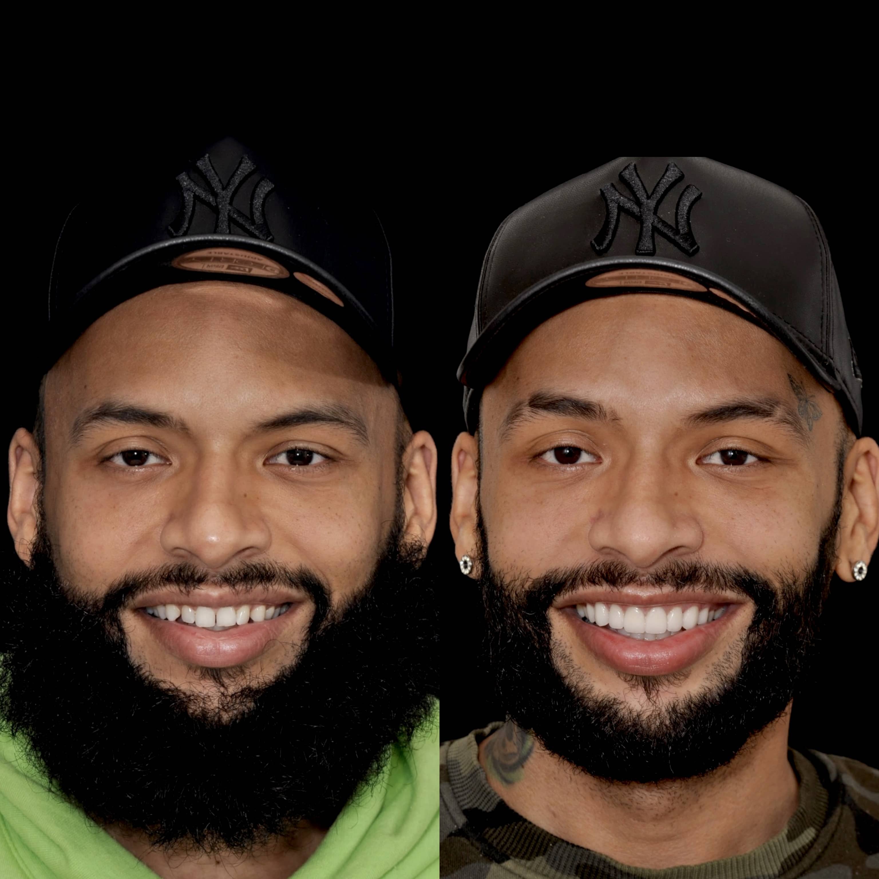 Porcelain Veneers